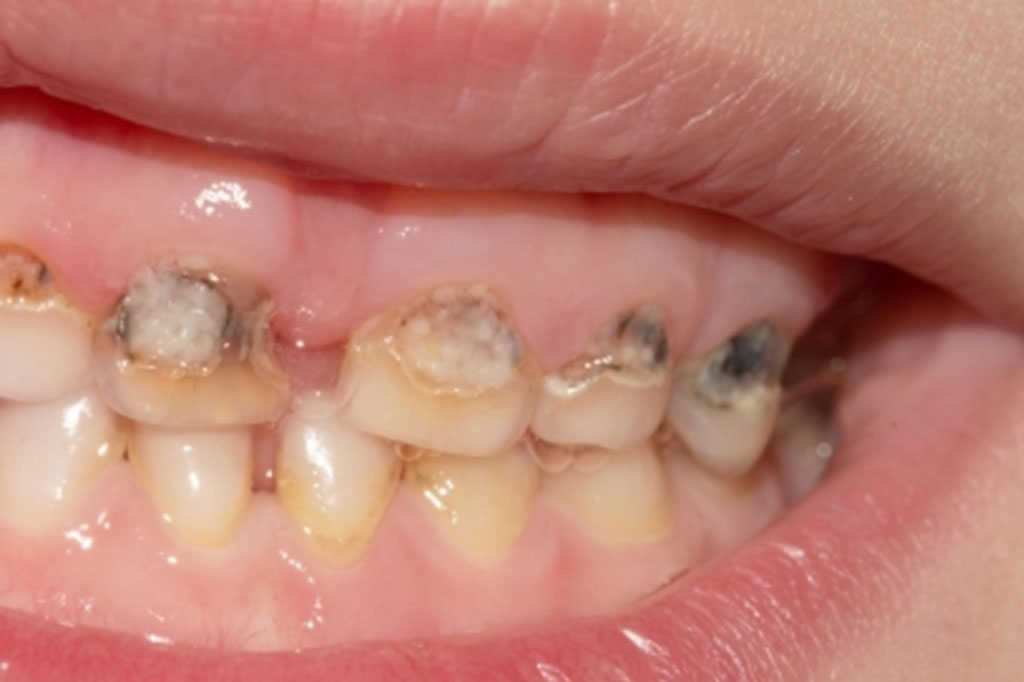 Necrosi dentale sintomi cause e cura per il dente morto